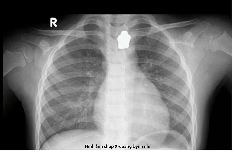 Bé gái nuốt nam châm và dị vật cản quang vùng cổ. Ảnh: BVCC Bé gái 5 tuổi nuốt nam châm trong lúc ăn cơm