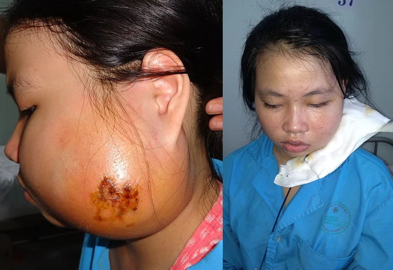 Cắt bỏ thành công khối u gây biến dạng khuôn mặt bé gái ảnh 1
