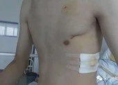 Tập thể dục cũng gây tràn khí màng phổi