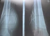70 cây đinh tự trồi ra khỏi chân 1 phụ nữ