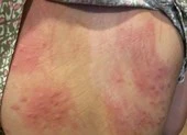 Đà Nẵng: Lấy mẫu nước, truy nguyên nhân gây ngứa sau tắm biển