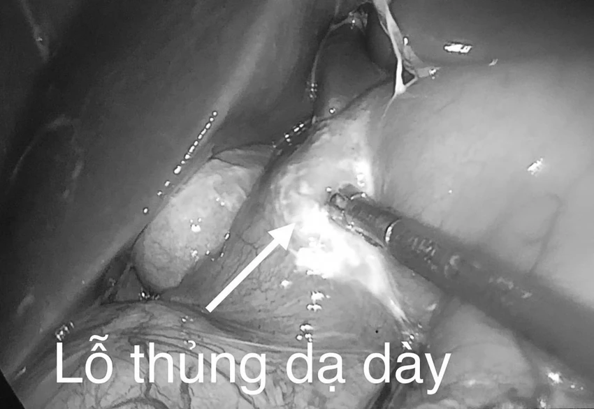 thủng dạ dày.jpg