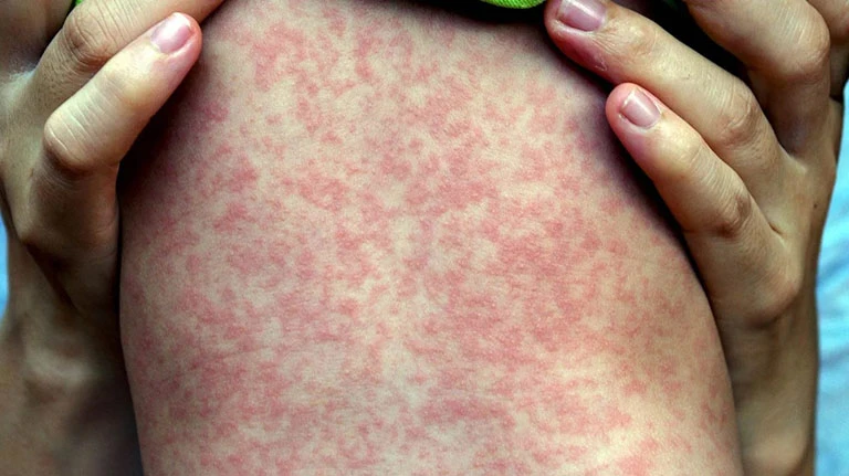rubella.jpg