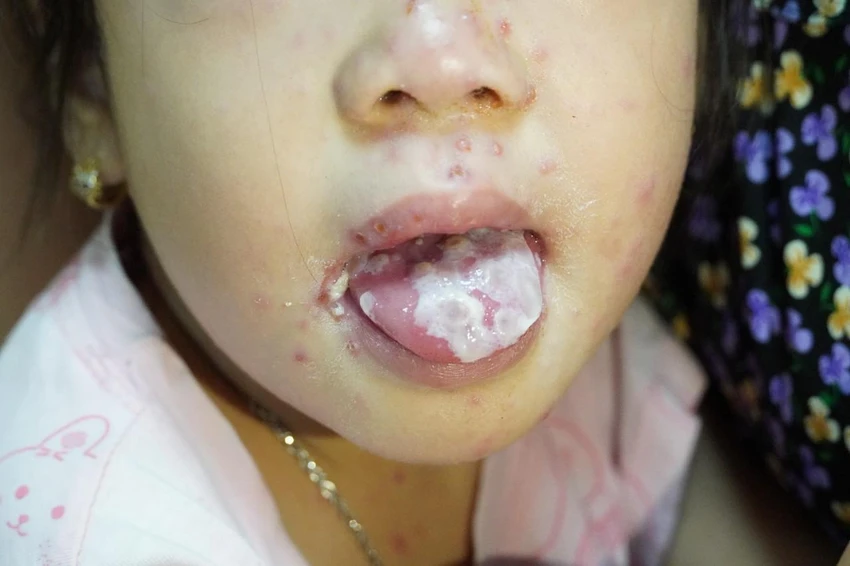 nhiễm trùng do thủy đậu.jpg