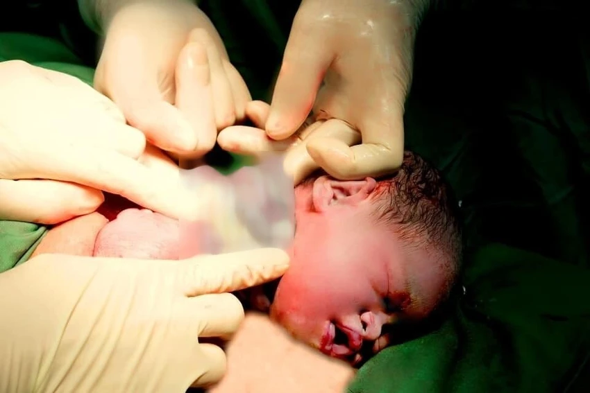 9 vòng dây rốn quấn cổ