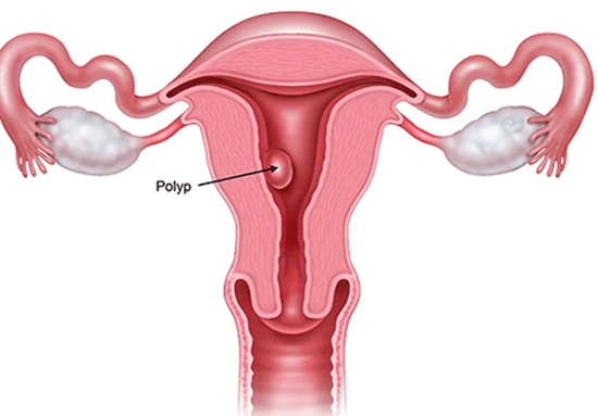 Polyp buồng tử cung