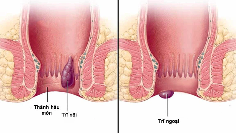 nguyên nhân gây bệnh trĩ
