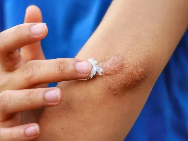 gel ngừa sẹo