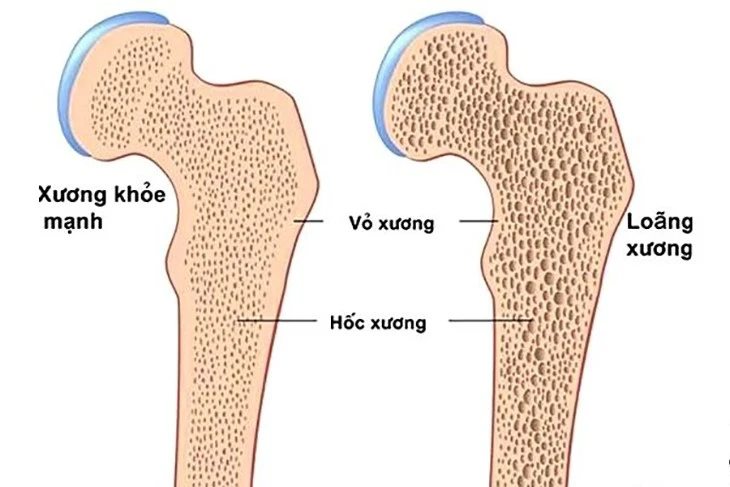 bệnh loãng xương