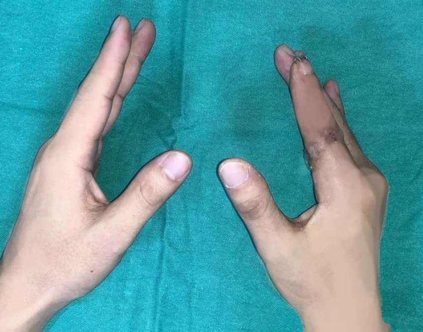 Ngón tay đứt rời