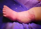 Bố mẹ đắp lá chữa bỏng nước sôi khiến bé 9 tháng tử vong