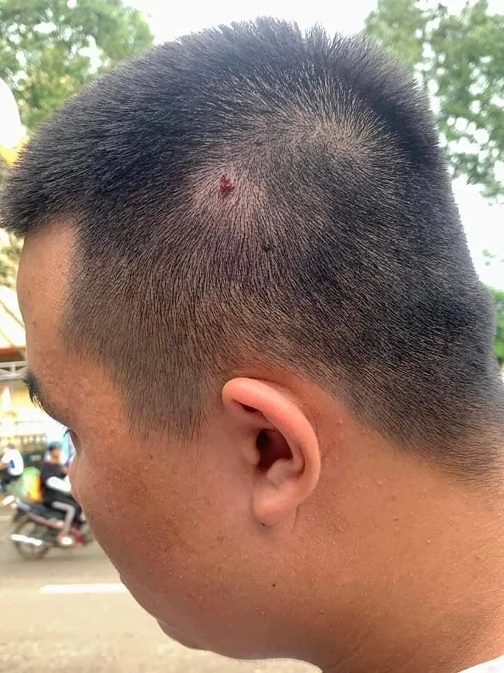 Một em học sinh bị thương vùng đầu. Ảnh: CTV Một em học sinh bị thương vùng đầu. Ảnh: CTV