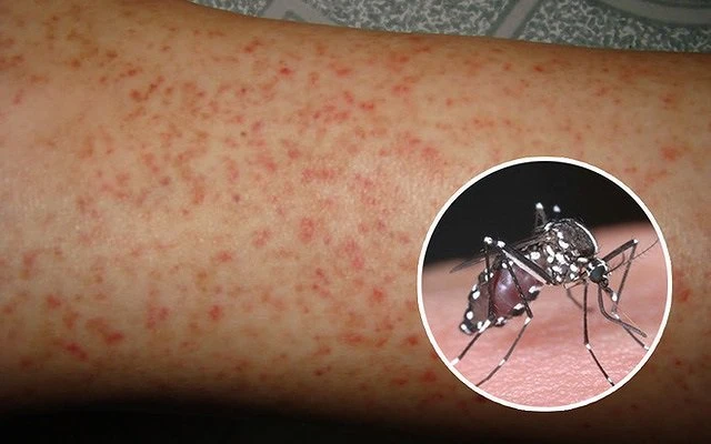 Do hiện nay chưa có vaccine, việc phòng bệnh sốt xuất huyết vẫn chủ yếu là phòng tránh muỗi đốt. Ảnh minh hoạ Do hiện nay chưa có vaccine, việc phòng bệnh sốt xuất huyết vẫn chủ yếu là phòng tránh muỗi đốt. Ảnh minh hoạ