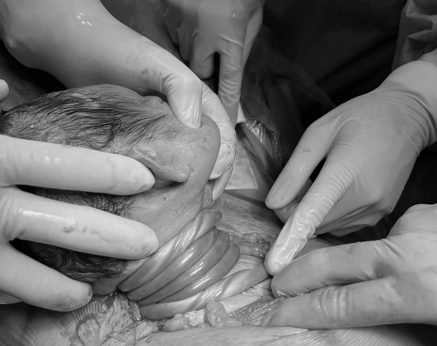 Bé sơ sinh để lại ấn tượng lớn với các bác sĩ khi có 5 vòng dây rốn quấn cổ siết chặt. Ảnh: BVCC