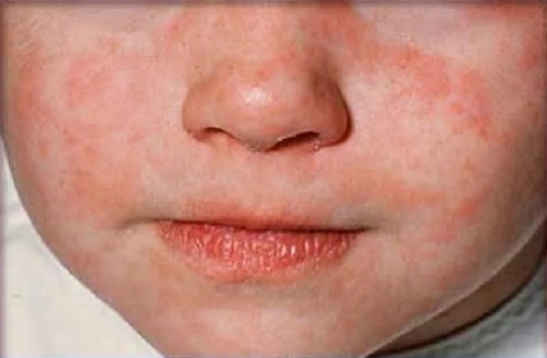 Phân biệt bệnh sởi và thủy đậu ảnh 1 Phân biệt bệnh sởi và thủy đậu ảnh 1