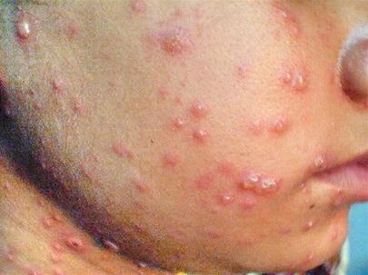 Phân biệt bệnh sởi và thủy đậu ảnh 2 Phân biệt bệnh sởi và thủy đậu ảnh 2