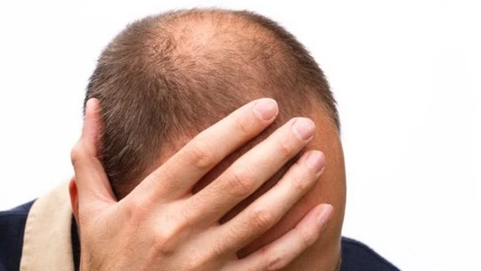 Hói đầu và ung thư tuyến tiền liệt: Có liên quan! ảnh 1