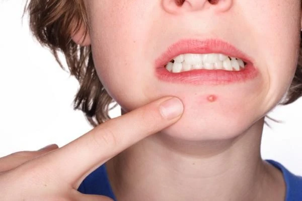 Cách điều trị mụn trứng cá ảnh 1