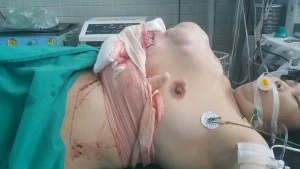 Cứu sống bệnh nhân mang u xương ức to bằng cái tô ảnh 1 Cứu sống bệnh nhân mang u xương ức to bằng cái tô ảnh 1
