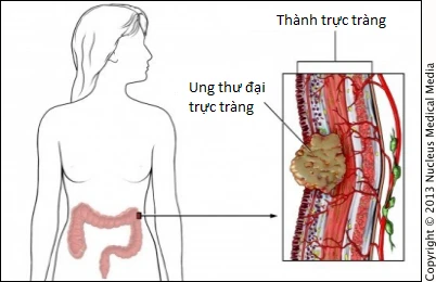 6 cách giảm nguy cơ bị ung thư trực tràng ảnh 1