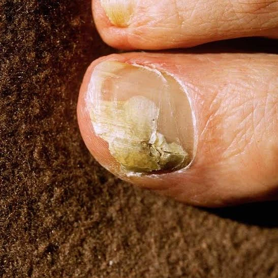 6 mẹo dễ dàng giúp trị bệnh nấm móng ảnh 1 6 mẹo dễ dàng giúp trị bệnh nấm móng ảnh 1
