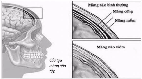 lao màng não
