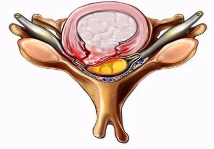 thoát vị đĩa đệm đau đớn
