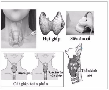ung thư tuyến giáp