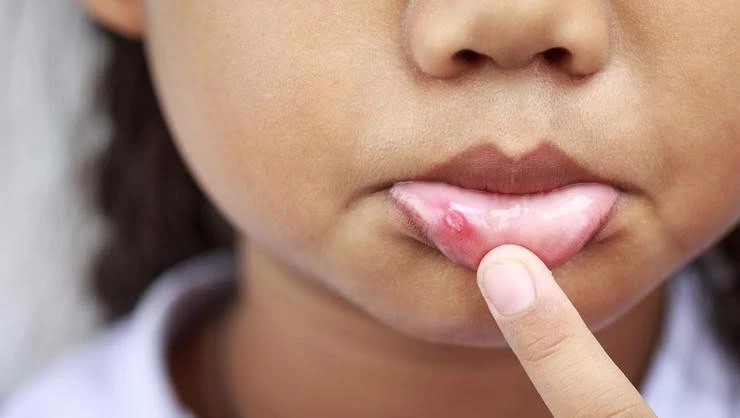 6 cách tự nhiên chữa lở miệng ảnh 2 lở miệng nhiệt miệng