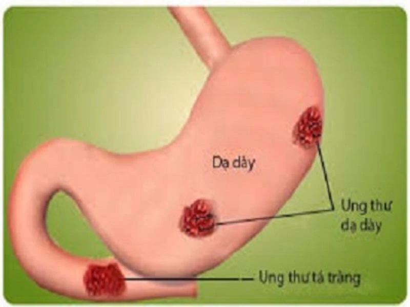 Cách phát hiện sớm ung thư đường tiêu hóa ảnh 2 ung thư dạ dày