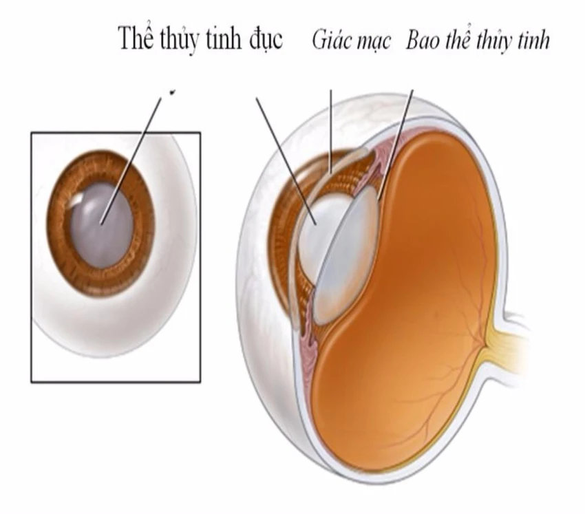 đục thủy tinh thể
