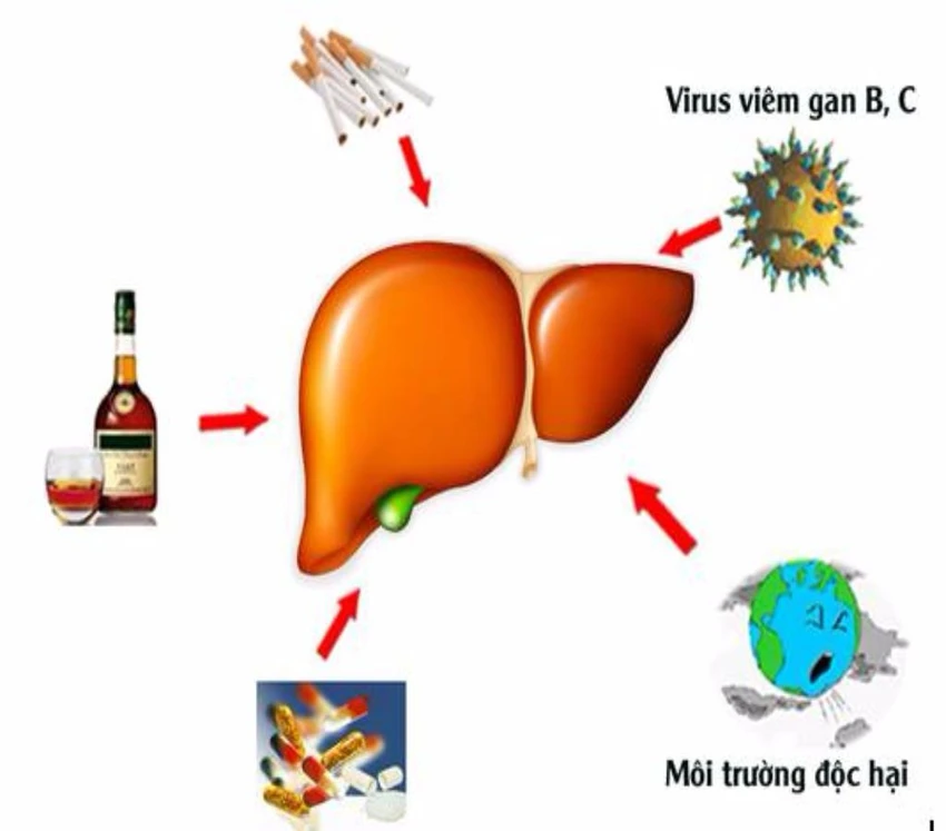 nguyên nhân gan nhiễm mỡ