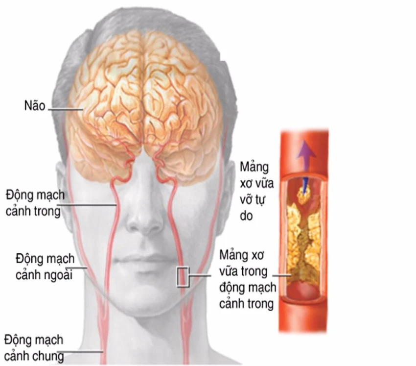 bệnh thiếu máu não