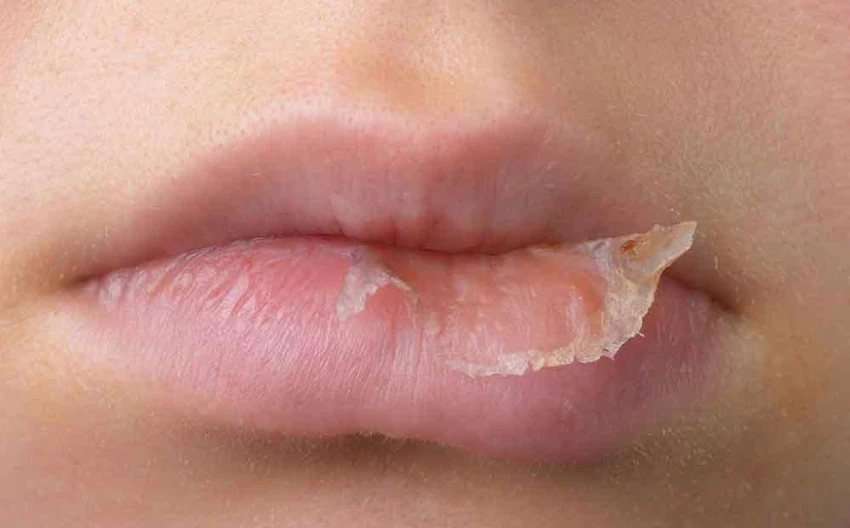 dị ứng son môi