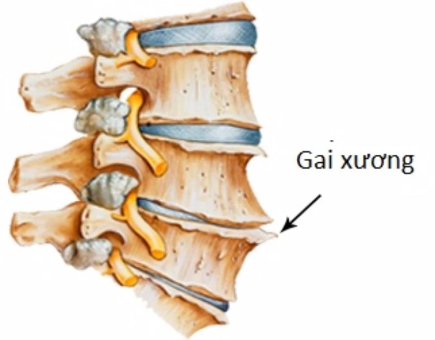 Thoái hóa đĩa đệm cột sống là một nguyên nhân hình thành gai xương cột sống