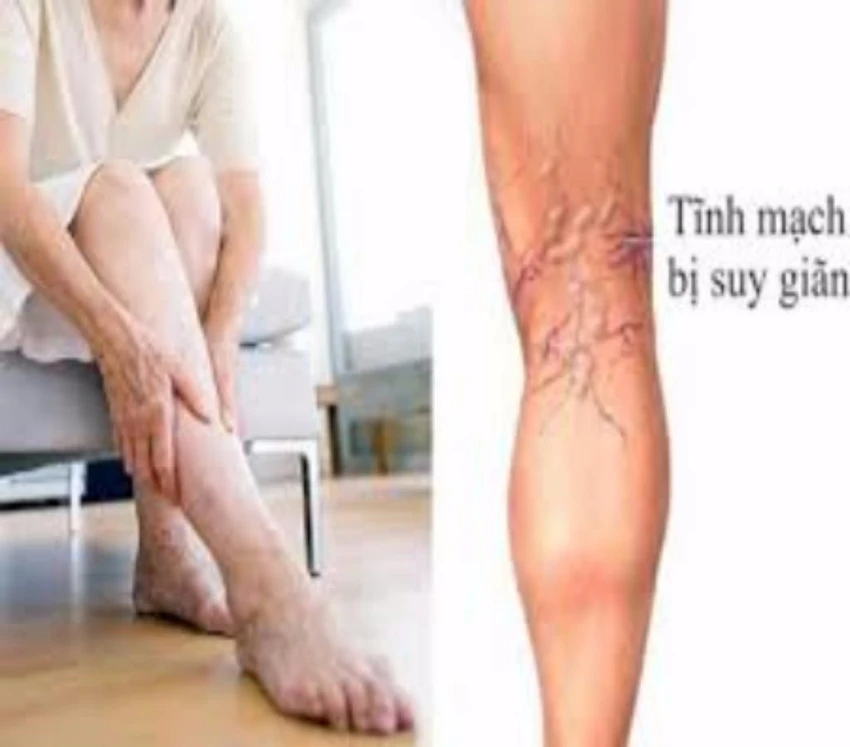 i gân xanh ở bắp chân là dấu hiệu của bệnh suy giãn tĩnh mạch.