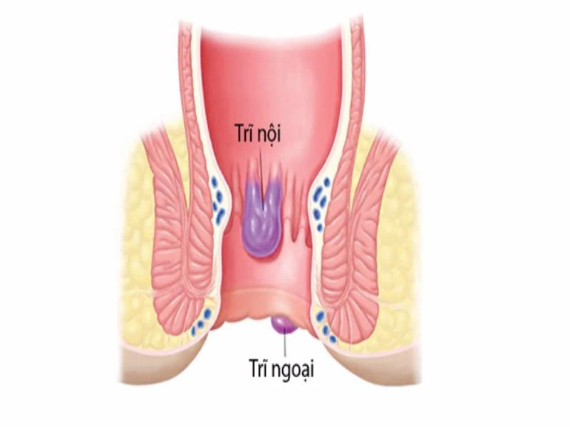 Nhận biết bệnh trĩ ảnh 1 nhận biết bệnh trĩ