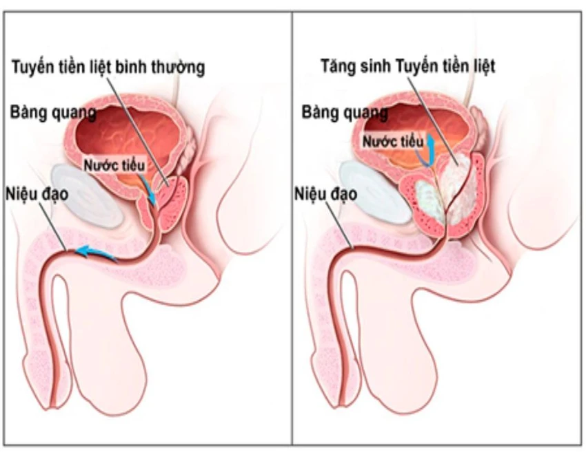 phì đại tiền liệt tuyến