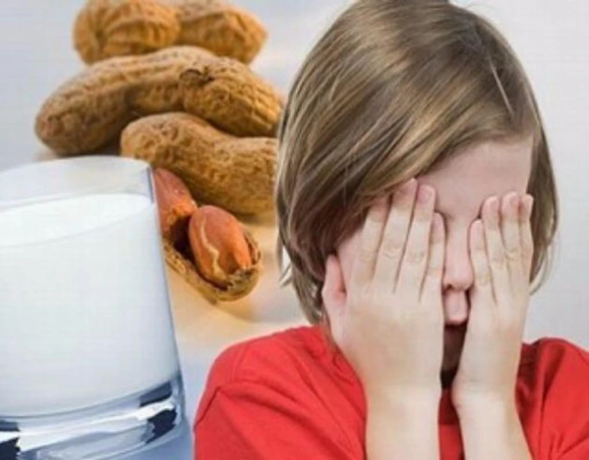 bị dị ứng đậu phộng