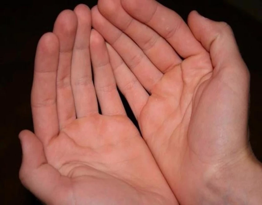 Hầu hết người có vân tay xoắn ốc có nguy cơ mắc bệnh tăng huyết áp cao. 