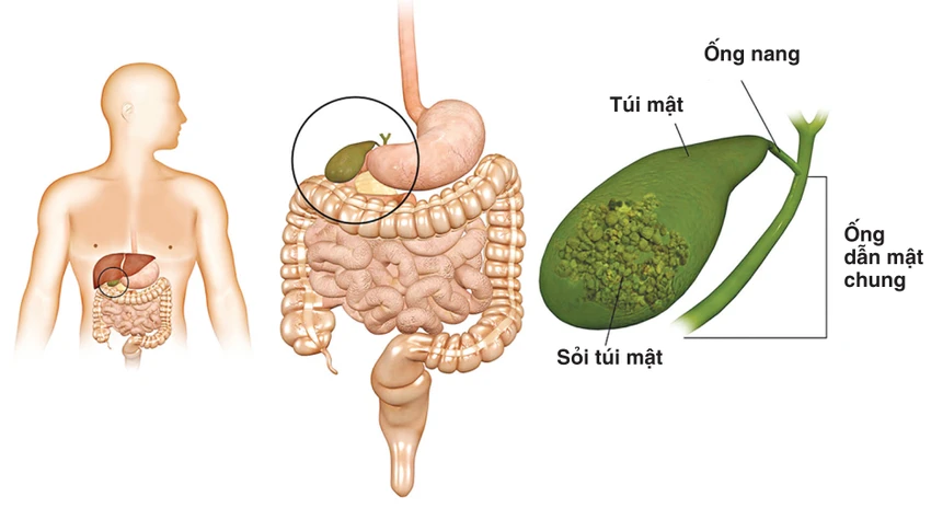 Sỏi mật do đâu mà có? ảnh 1 Sỏi mật do đâu mà có? ảnh 1