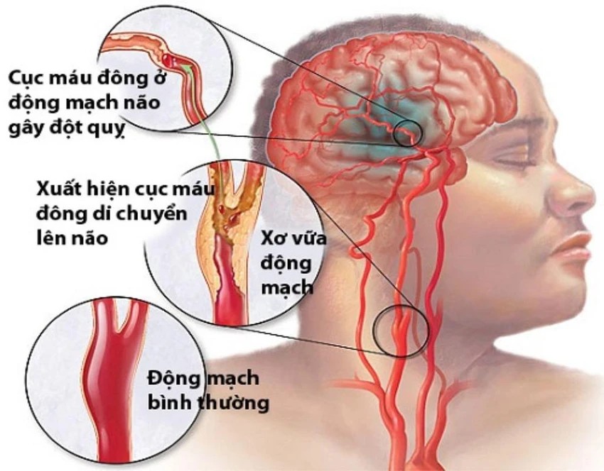 Đột quỵ là căn bệnh nguy hiểm, gây tử vong chỉ sau các bệnh về tim mạch và ung thư.