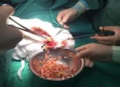 Kinh hoàng ổ giun lớn gây tắc ruột bé 3 tuổi