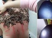 Thực hư việc trị bệnh đậu lào bằng lông và máu gà