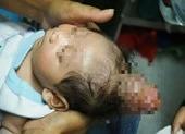 Cậu bé mọc 'sừng' trên đầu như kỳ lân