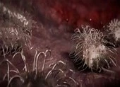 Bị vi khuẩn 'ăn thịt người’ ăn mất nửa gương mặt