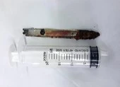 Lưỡi dao bị 'bỏ quên' trong... lưng bệnh nhân 11 năm