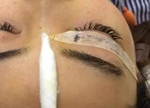 Nhấn mí làm đẹp, cô gái bị cây kim 'chơi ú tim' trong mắt