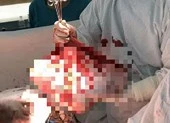 Bóc tách thành công khối u buồng trứng khổng lồ 