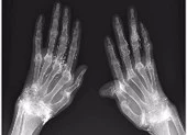 Dùng vàng khâu khớp tay để trị thấp khớp